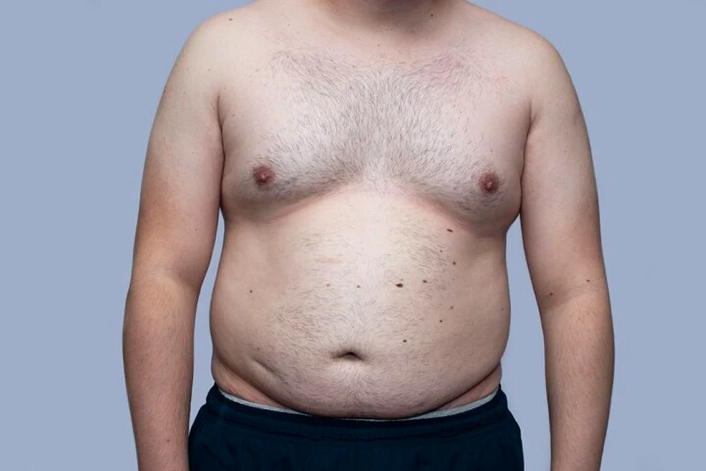 “Man Boobs” Aren’t a Joke — Let’s Talk About Gynaecomastia Seriously