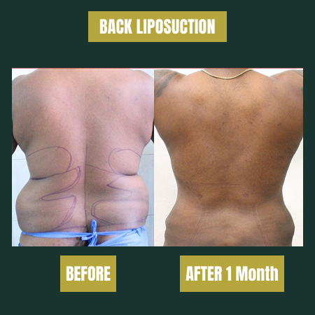 back-lipsuction-b-a