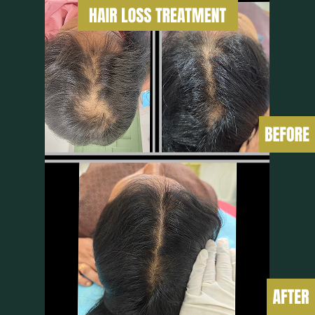 hair-loss-treatment-bf