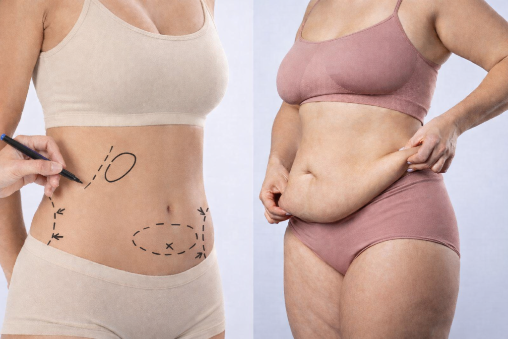 Liposuction vs. Tummy Tuck