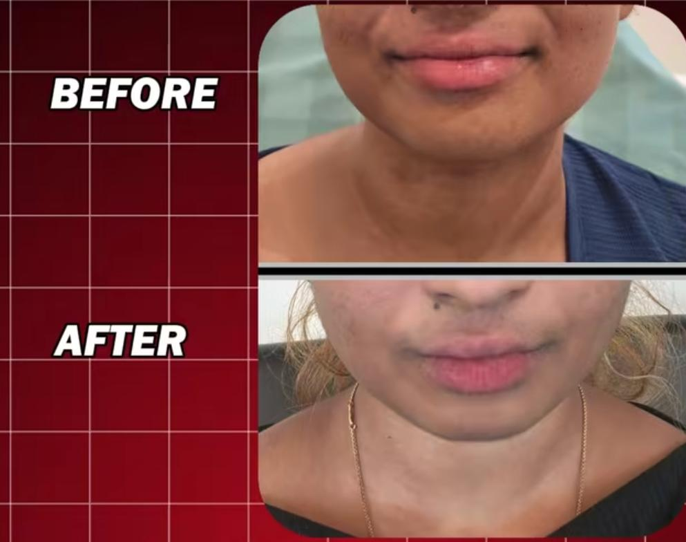 Before and after results of Cosmelan Peel treatment showing reduced facial pigmentation, improved skin tone, and a brighter complexion.