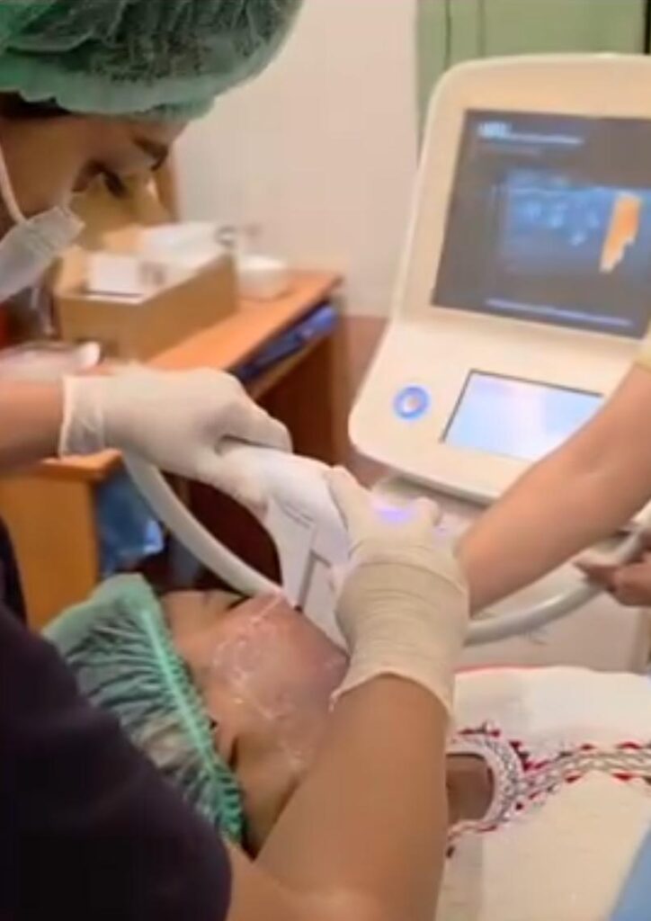 HIFU Face Treatment procedure using focused ultrasound technology to tighten skin, stimulate collagen production, and achieve a non-surgical facial lift