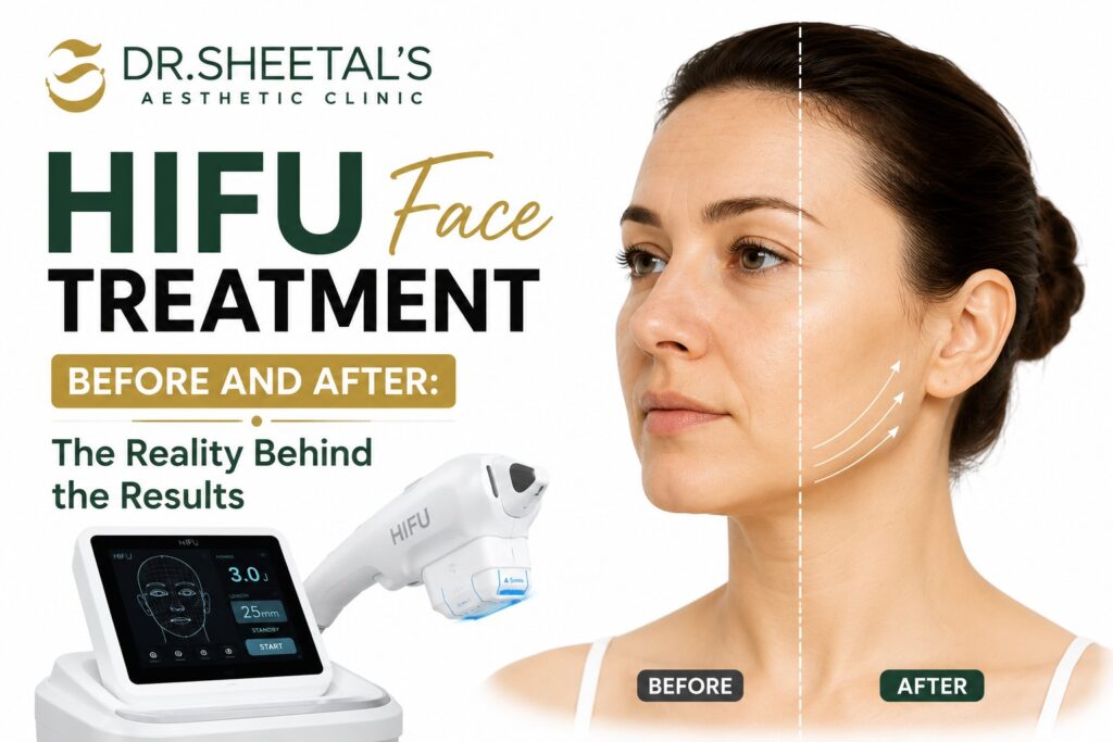 HIFU face treatment before and after results — skin lifting and tightening shown on a woman's jawline and cheek at Dr. Sheetal's Aesthetic Clinic