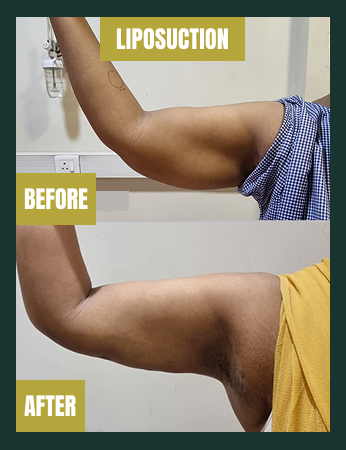 Before and after arm liposuction showing reduced upper arm fat and improved body contour after treatment in India.