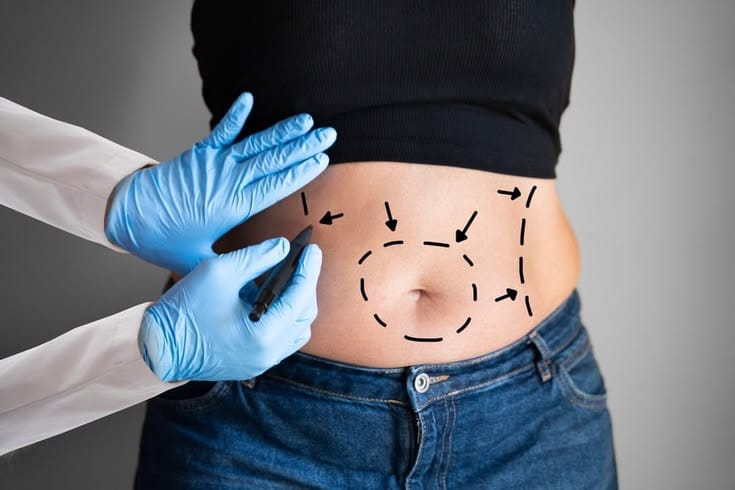 Plastic surgeon marking the abdomen before liposuction body contouring procedure for a UAE patient travelling to India.