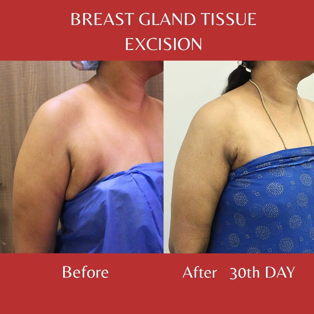 Breast gland tissue excision before and after result showing reduced underarm breast tissue on the 30th day